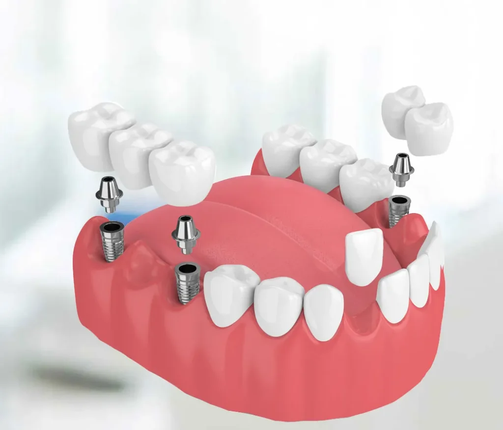 Multiple Teeth Implant & Implant Bridge
